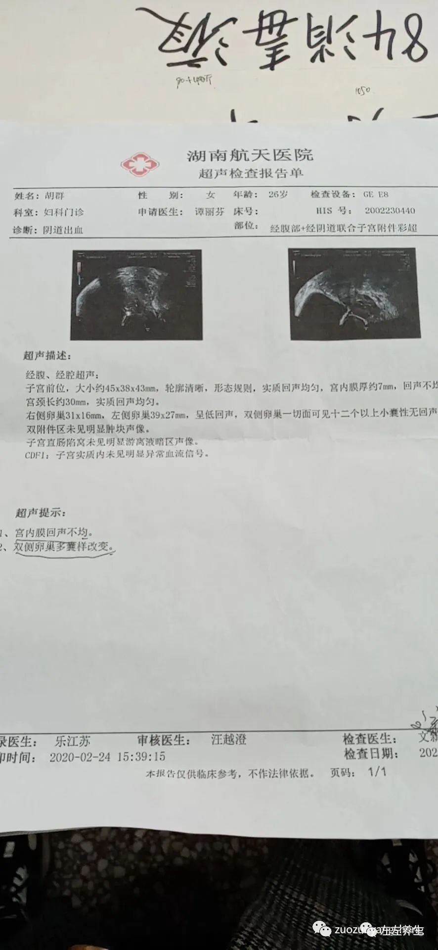 案例分享:多囊卵巢综合征与月经长达三个月的案例 案例分享:多囊卵巢综合征与月经长达三个月的案例