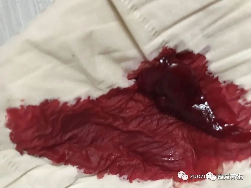 案例分享:子宫大出血调理案例 案例分享:子宫大出血调理案例