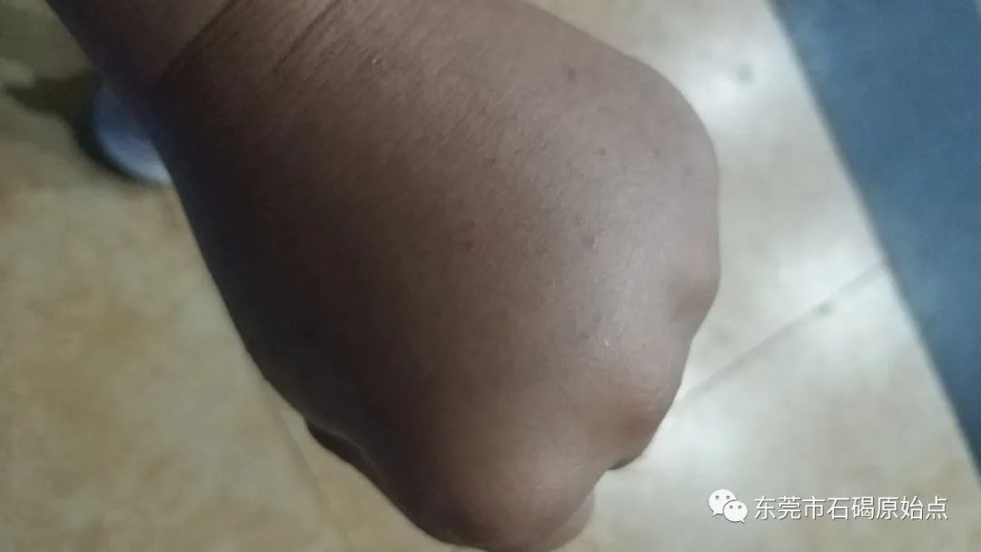 双手肿,胀痛,原始点调理3天康复 双手肿,胀痛,原始点调理3天康复