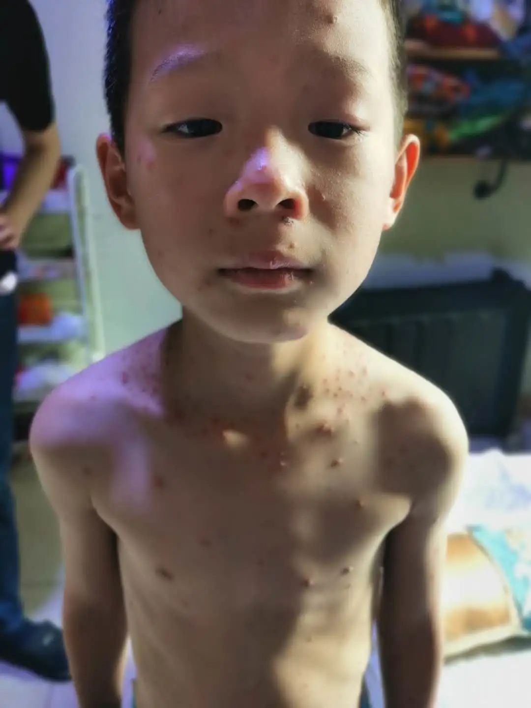 【原始点案例】原始点调理孩子水痘案例! 【原始点案例】原始点调理孩子水痘案例!