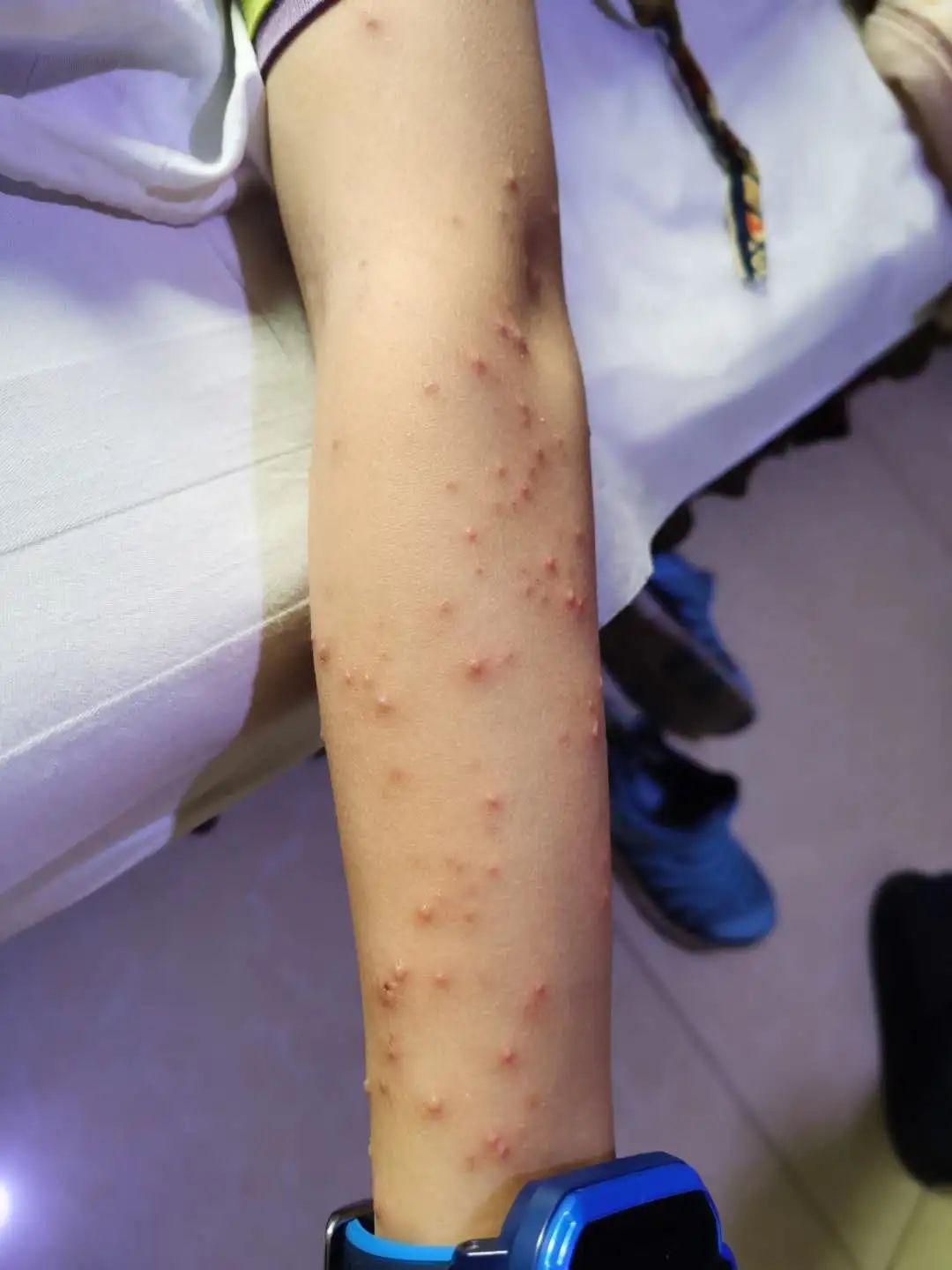 【原始点案例】原始点调理孩子水痘案例! 【原始点案例】原始点调理孩子水痘案例!