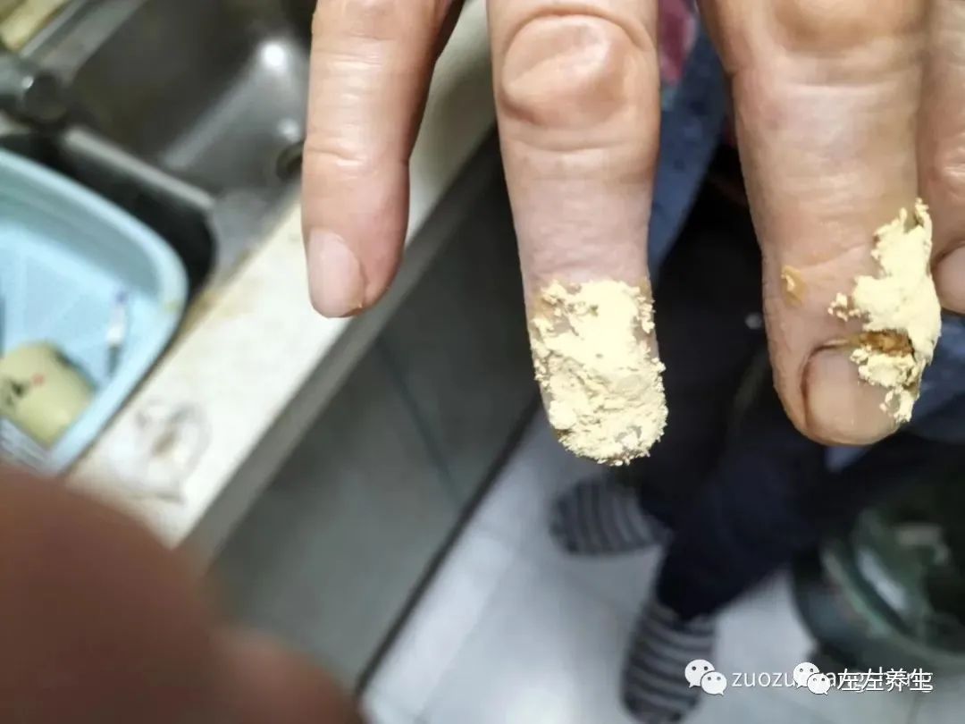 案例分享：手指夹伤后血流不止调理案例