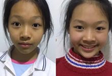 案例分享:儿童全身痒调理案例-七不姜 生姜养生网-明德CSA生态姜园&明安农业