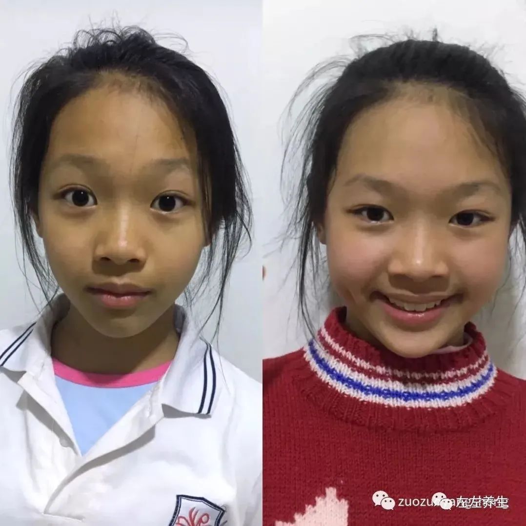 案例分享:儿童全身痒调理案例-七不姜 生姜养生网-明德CSA生态姜园&明安农业