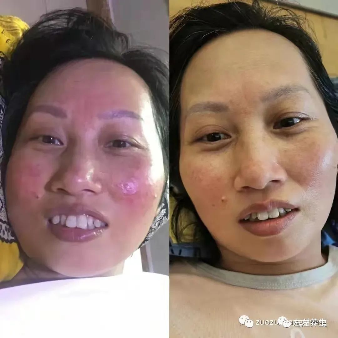 案例分享:脸上玫瑰痤疮调理案例 案例分享:脸上玫瑰痤疮调理案例