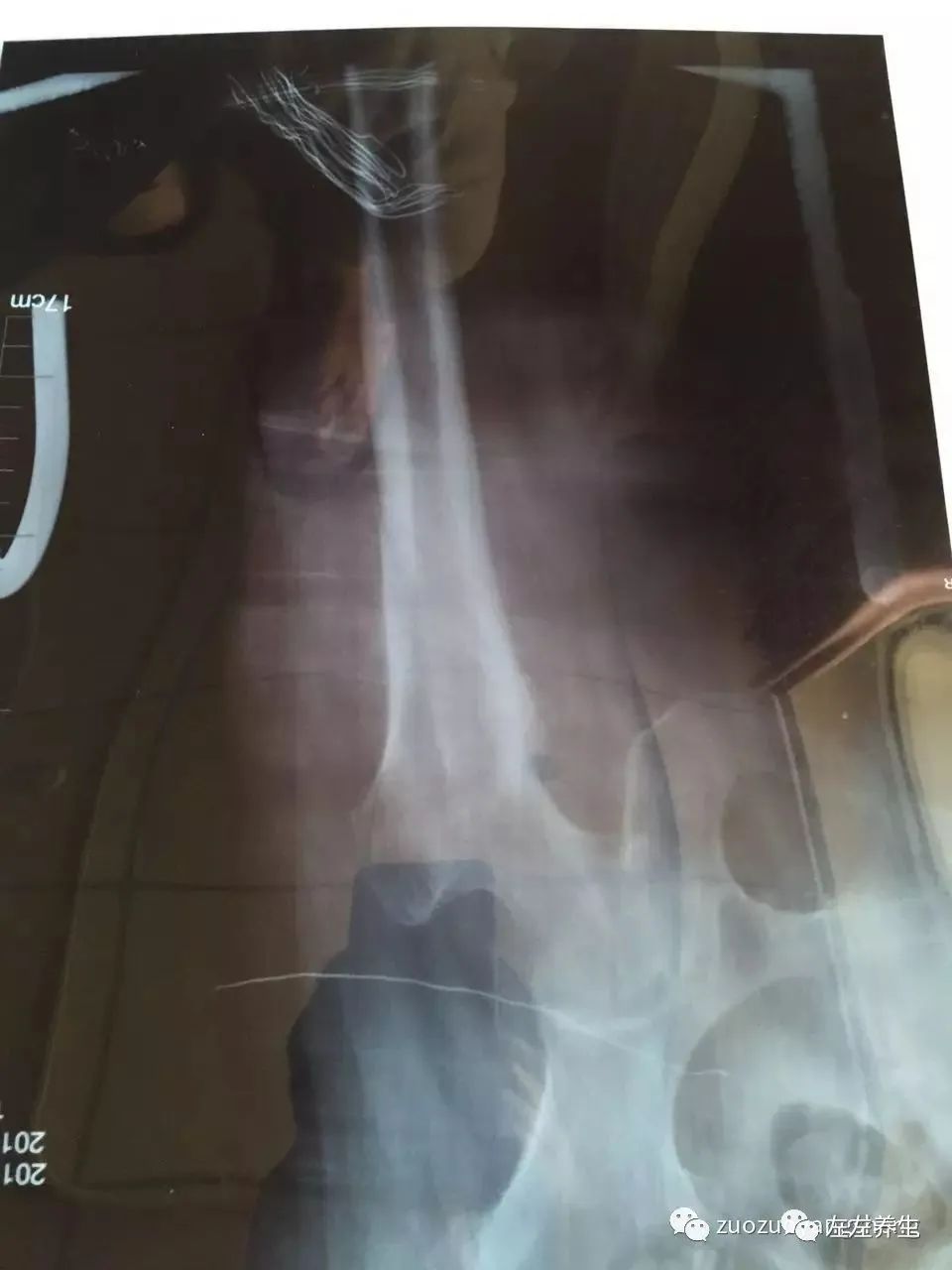 案例分享：又一奇迹：83岁婆婆骨折错位没开刀没手术6周康复