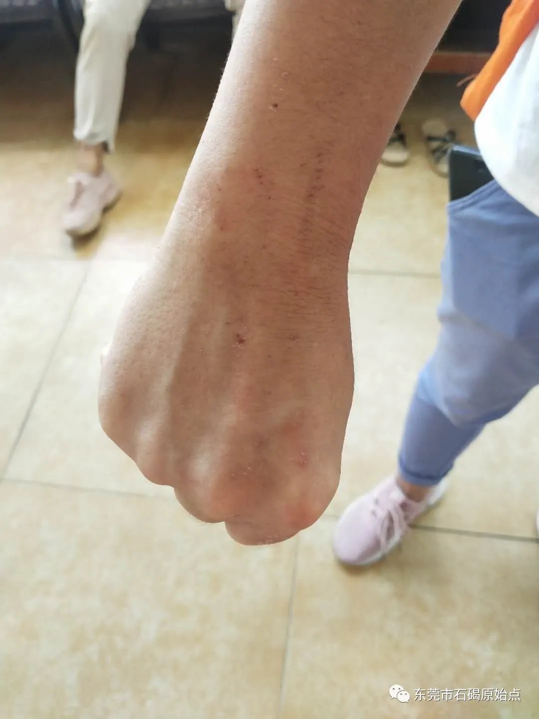 双手肿,胀痛,原始点调理3天康复 双手肿,胀痛,原始点调理3天康复