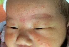 婴幼儿湿疹怎么办?(附手法视频)-七不姜 生姜养生网-明德CSA生态姜园&明安农业