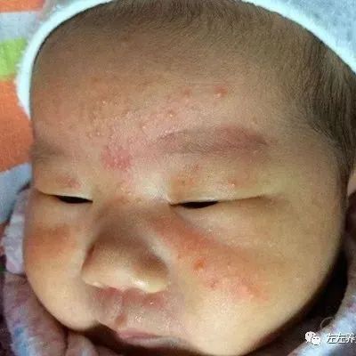 婴幼儿湿疹怎么办？（附手法视频）-七不姜 生姜养生网-明德CSA生态姜园&明安农业