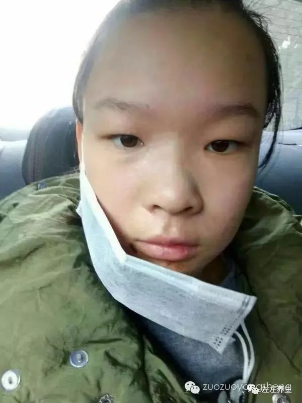 案例分享:花季少女面部烫伤不留疤的调理案例 案例分享:花季少女面部烫伤不留疤的调理案例