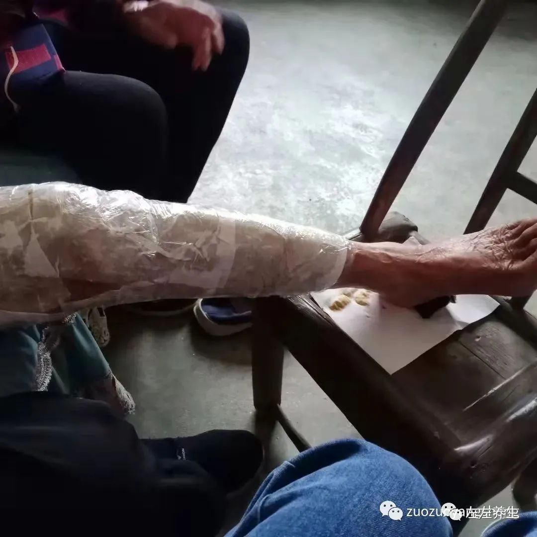 案例分享：85岁老人腿痛、无力，“种”发的案例