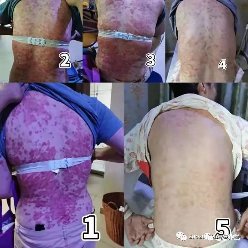 案例分享：20年牛皮癣调理案例