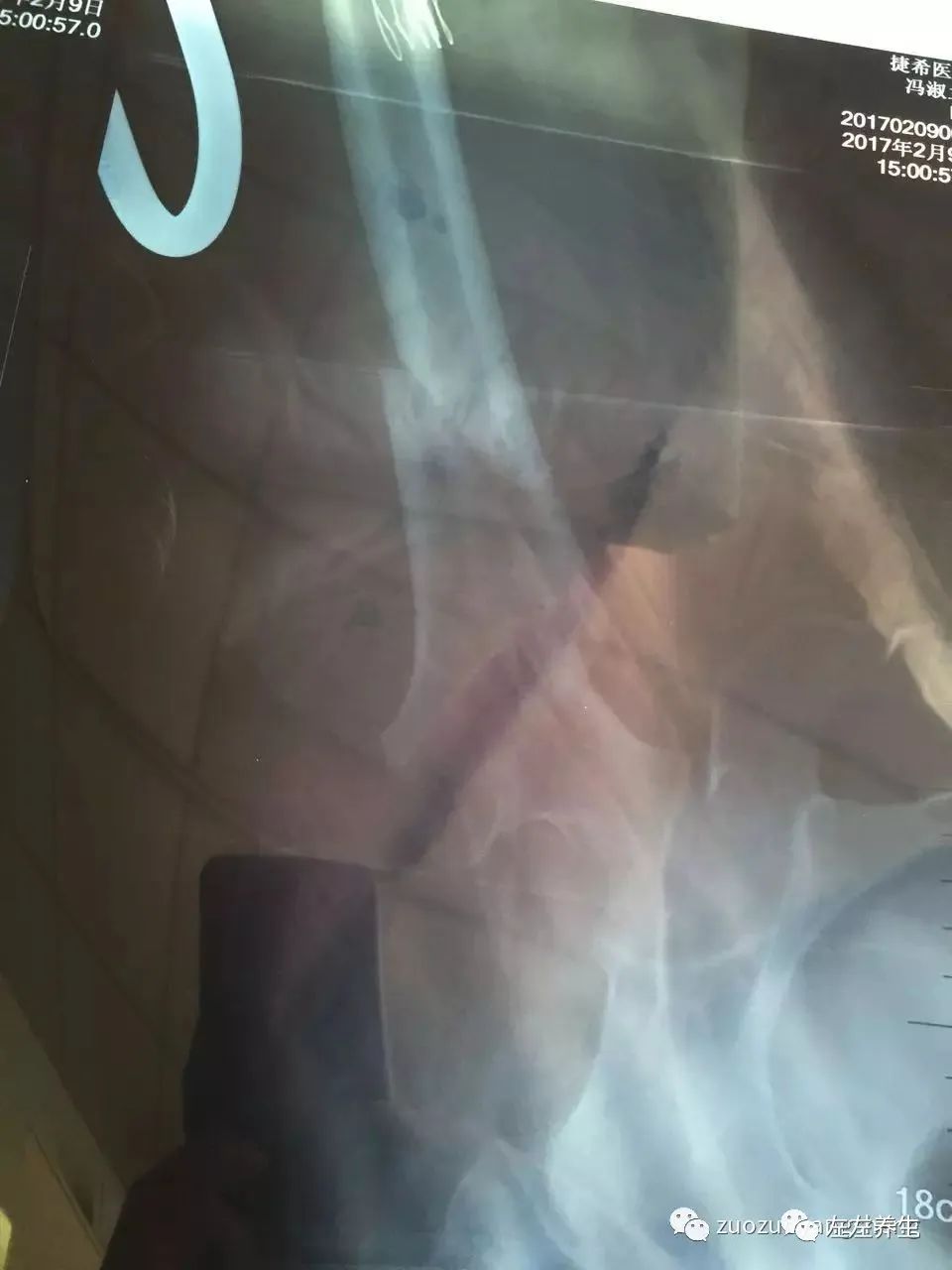 案例分享：又一奇迹：83岁婆婆骨折错位没开刀没手术6周康复