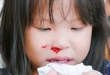 微问答283期:孩子频繁流鼻血原始点如何处理?-七不姜 生姜养生网-明德CSA生态姜园&明安农业