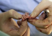 案例回访:三年前那位没去做心脏瓣膜置换术的女士情况怎么样了?-七不姜 生姜养生网-明德CSA生态姜园&明安农业