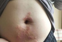 案例分享:腹部奇痒无比湿疹调理案例-七不姜 生姜养生网-明德CSA生态姜园&明安农业