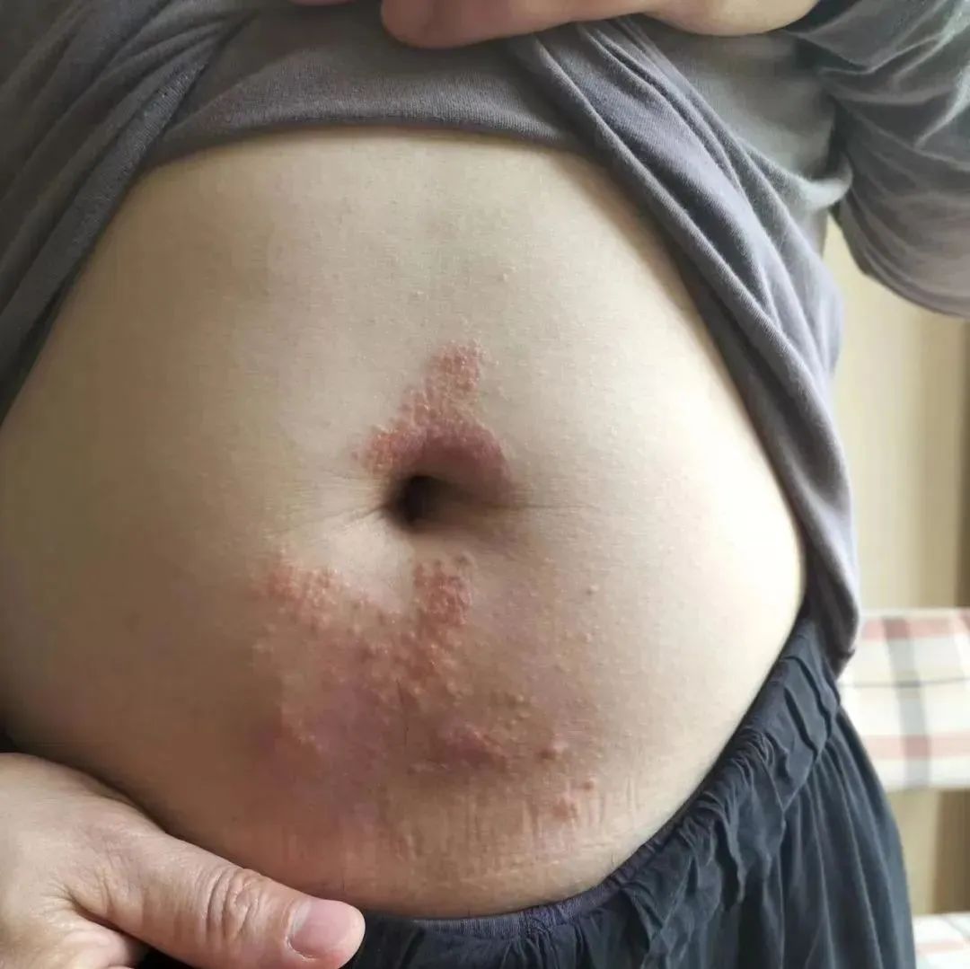 案例分享：腹部奇痒无比湿疹调理案例-七不姜 生姜养生网-明德CSA生态姜园&明安农业