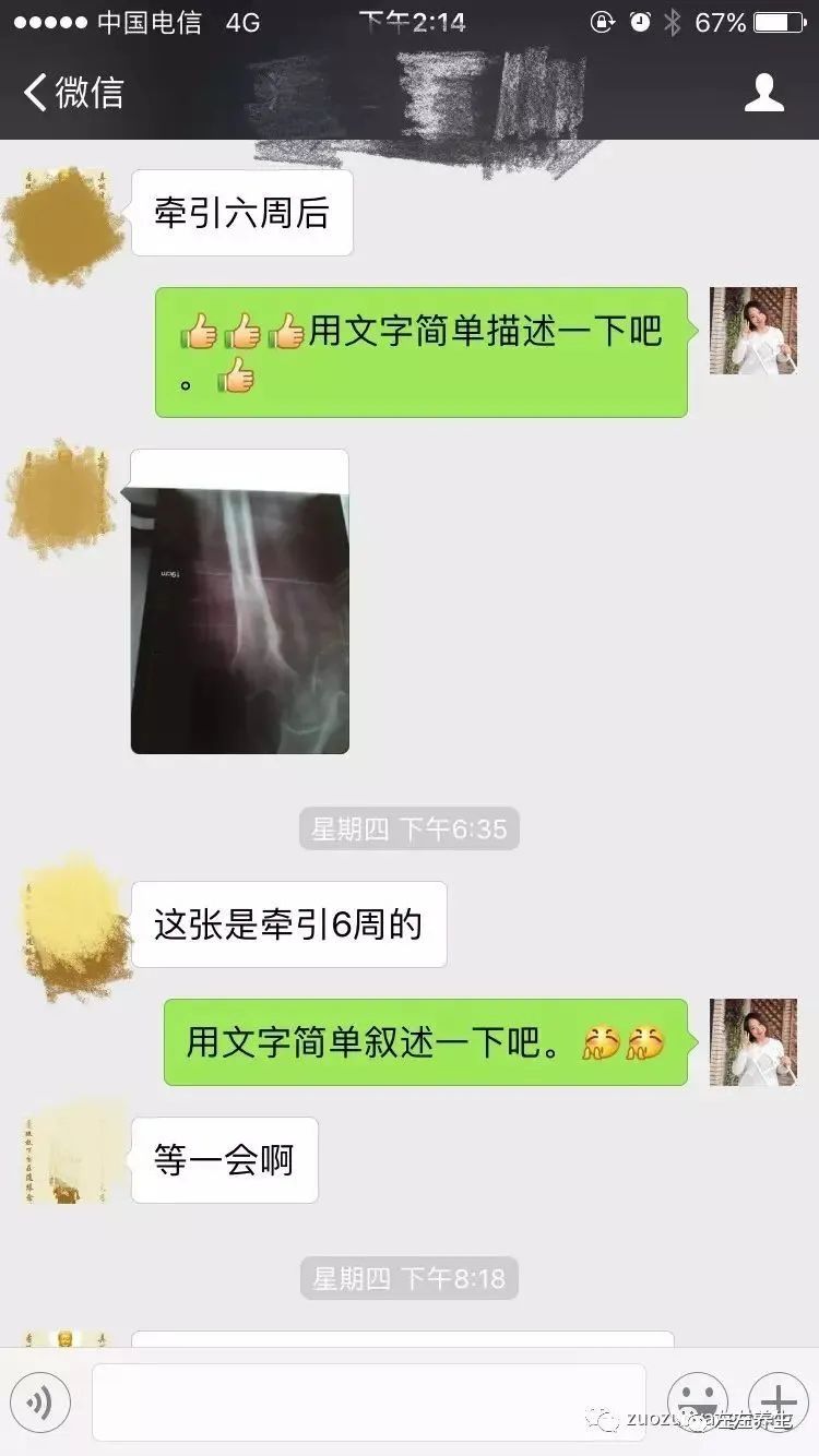 案例分享:又一奇迹:83岁婆婆骨折错位没开刀没手术6周康复 案例分享:又一奇迹:83岁婆婆骨折错位没开刀没手术6周康复