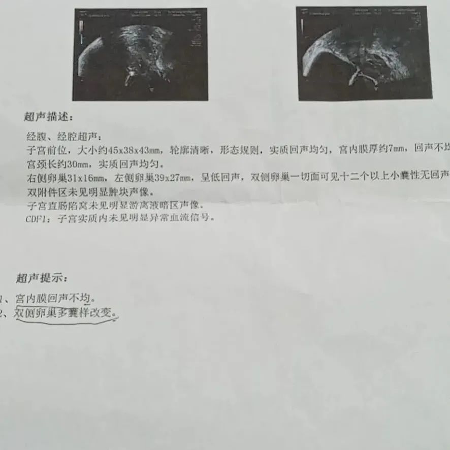 案例分享：多囊卵巢综合征与月经长达三个月的案例-七不姜 生姜养生网-明德CSA生态姜园&明安农业