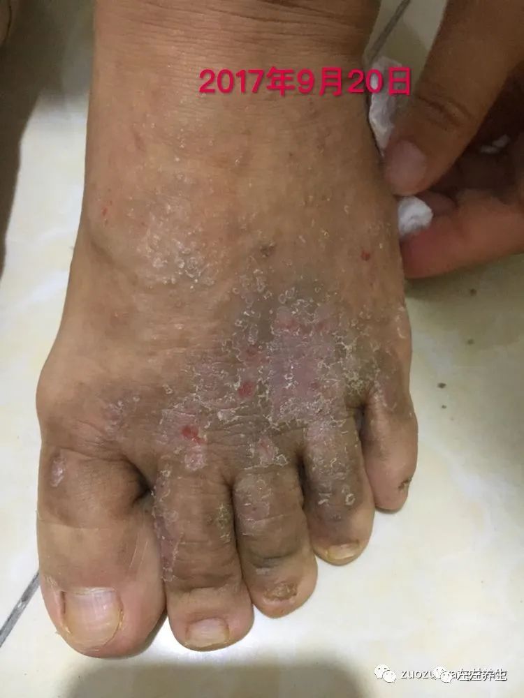 案例分享:全身奇痒无比的湿疹案例 案例分享:全身奇痒无比的湿疹案例