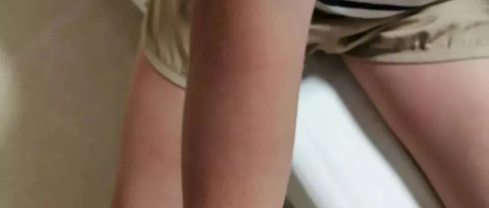 案例分享：突发性过敏全身痒调理案例-七不姜 生姜养生网-明德CSA生态姜园&明安农业