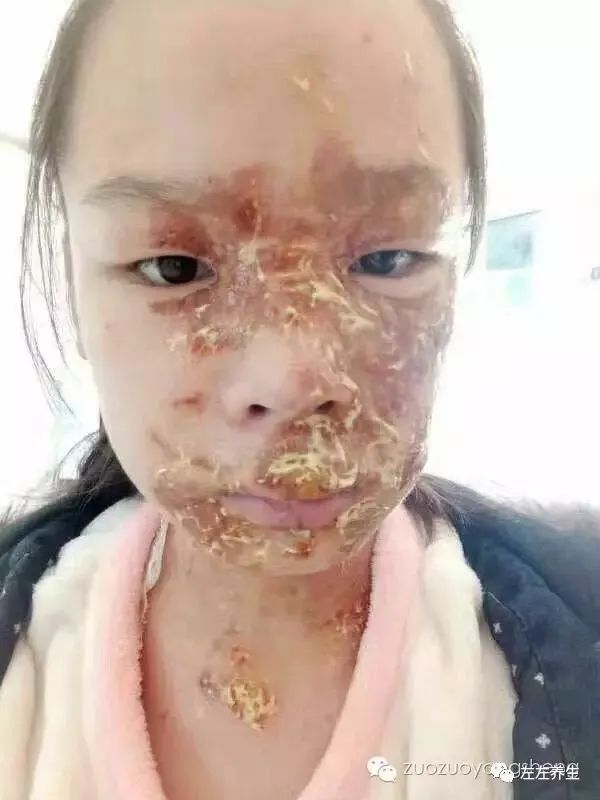 案例分享:花季少女面部烫伤不留疤的调理案例 案例分享:花季少女面部烫伤不留疤的调理案例