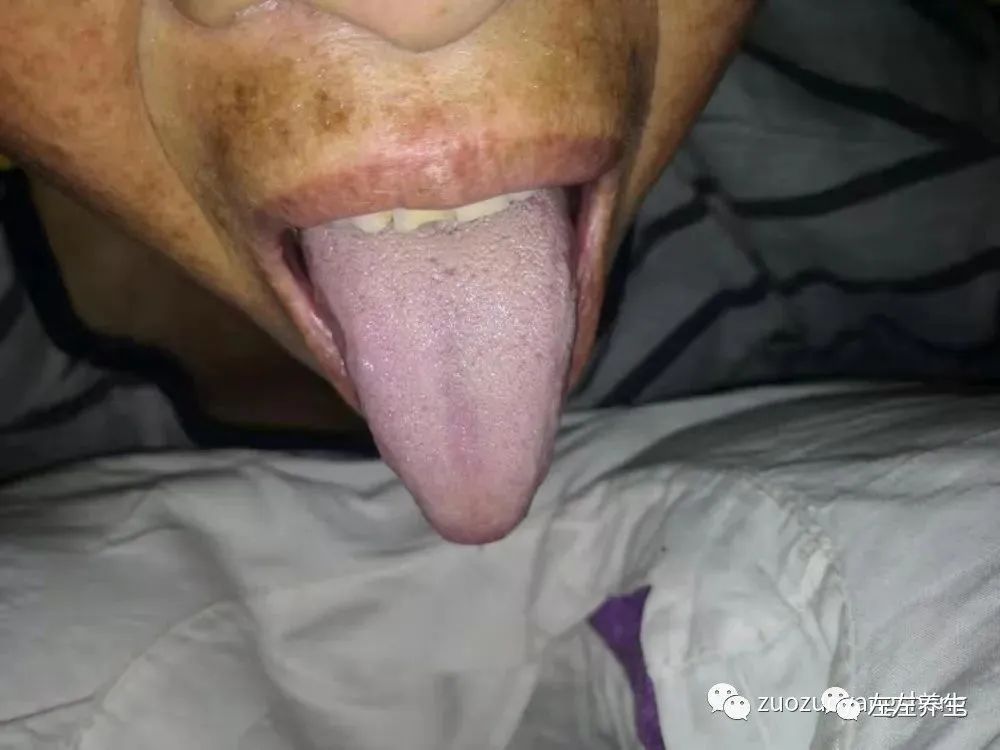 案例分享:70岁老人腹痛(医院初诊可能升结肠癌)飞蛾症、腿抽筋、失眠调理案例 案例分享:70岁老人腹痛(医院初诊可能升结肠癌)飞蛾症、腿抽筋、失眠调理案例