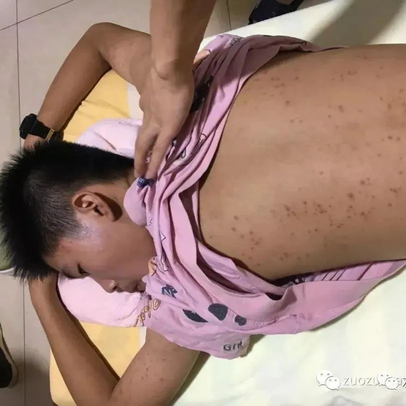 案例分享:14岁少年毛囊炎、全身痒、长痘痘的案例-七不姜 生姜养生网-明德CSA生态姜园&明安农业