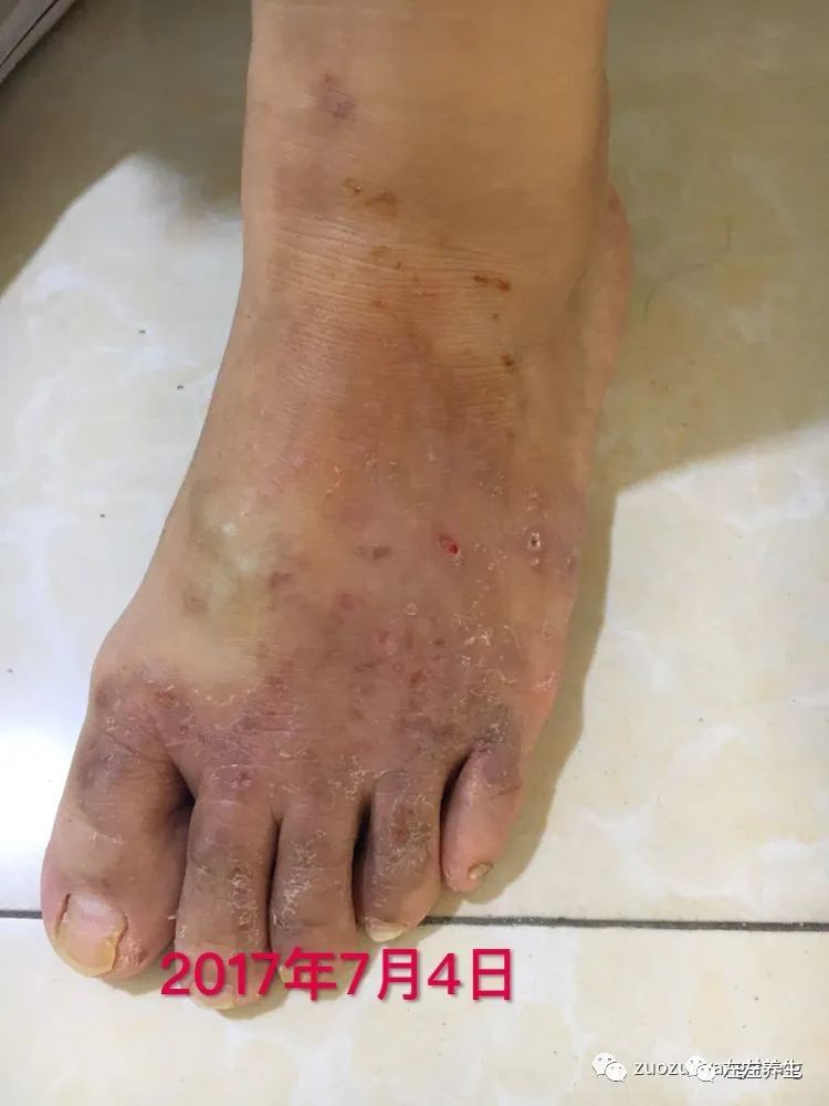 案例分享:全身奇痒无比的湿疹案例 案例分享:全身奇痒无比的湿疹案例