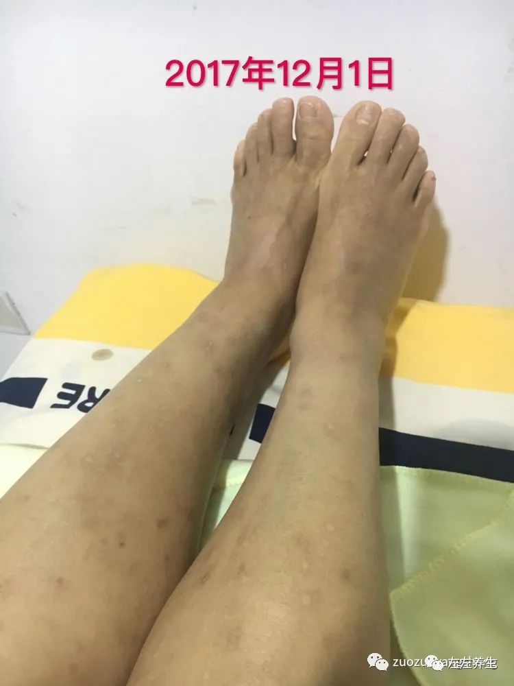 案例分享:全身奇痒无比的湿疹案例 案例分享:全身奇痒无比的湿疹案例