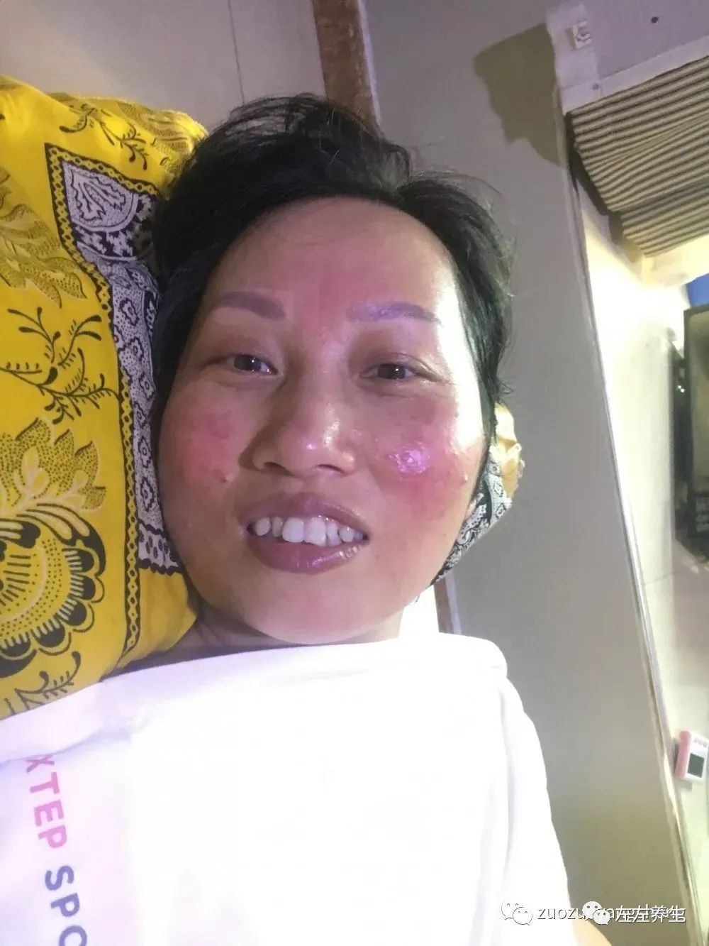 案例分享:脸上玫瑰痤疮调理案例 案例分享:脸上玫瑰痤疮调理案例