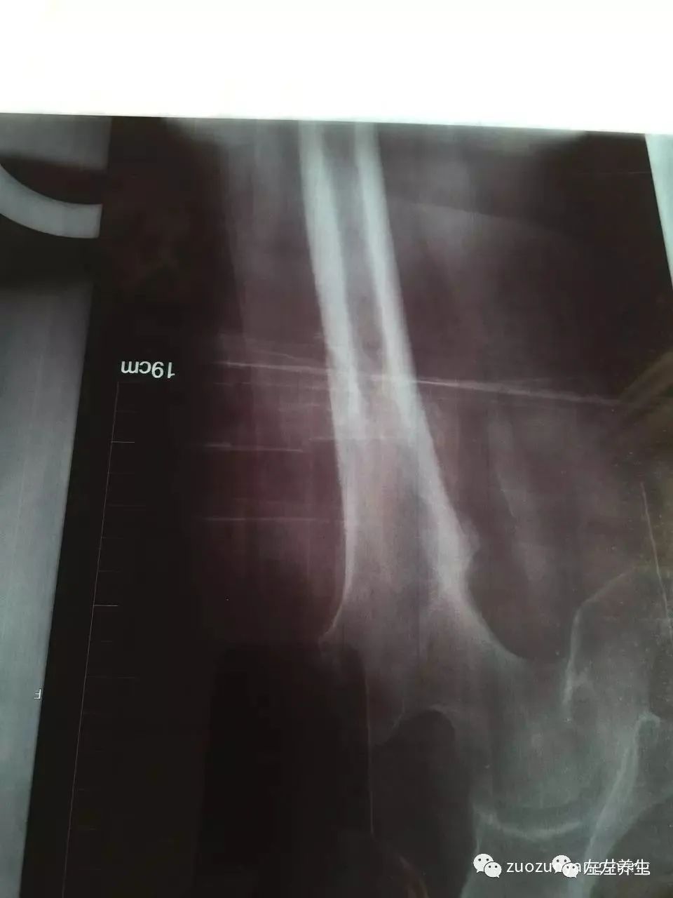 案例分享：又一奇迹：83岁婆婆骨折错位没开刀没手术6周康复