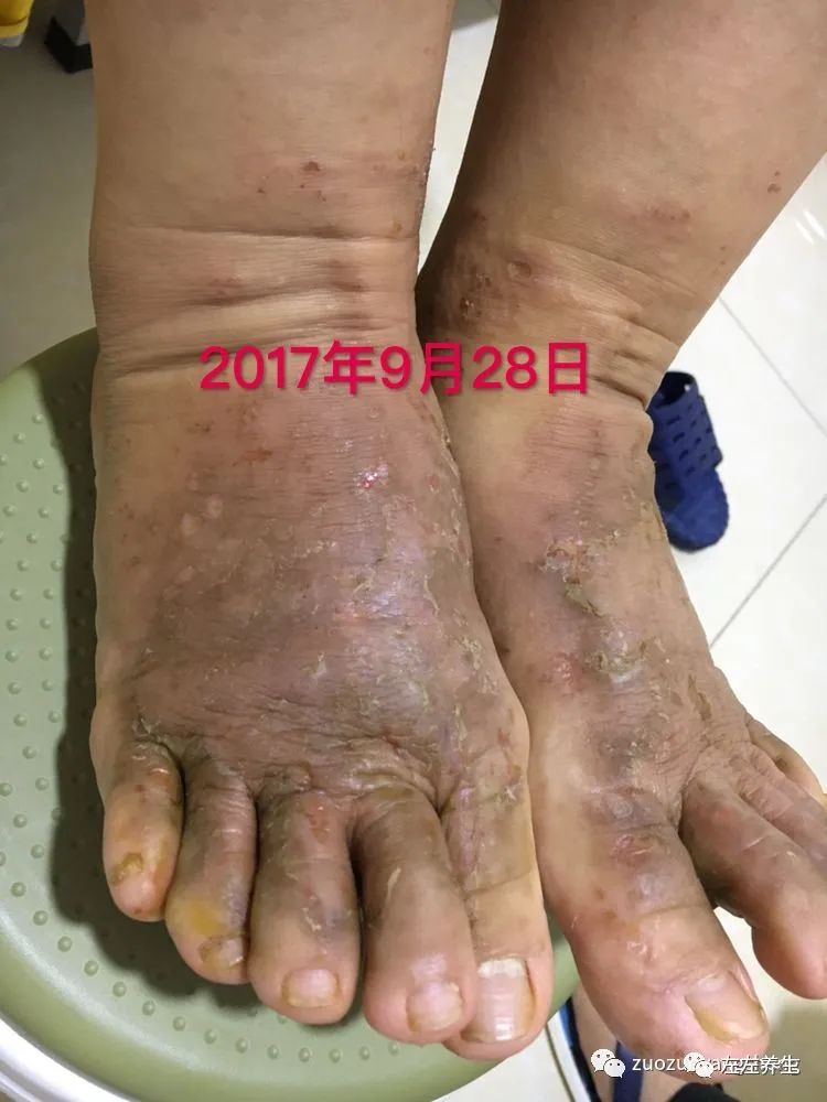 案例分享:全身奇痒无比的湿疹案例 案例分享:全身奇痒无比的湿疹案例