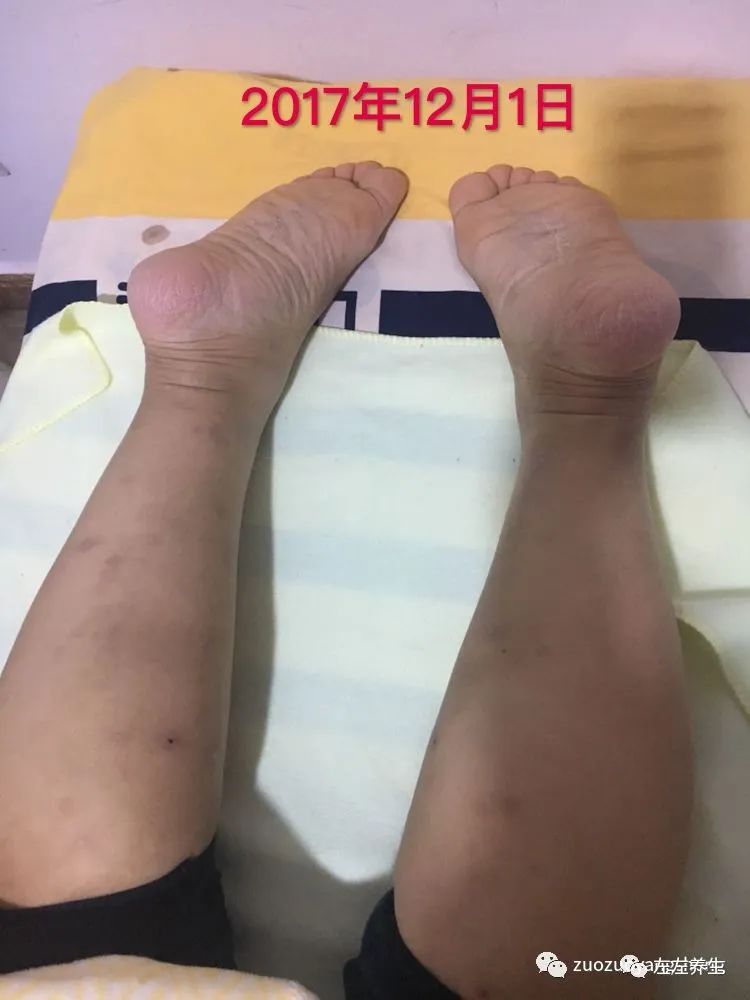 案例分享:全身奇痒无比的湿疹案例 案例分享:全身奇痒无比的湿疹案例