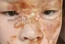 案例分享:花季少女面部烫伤不留疤的调理案例-七不姜 生姜养生网-明德CSA生态姜园&明安农业