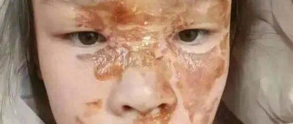案例分享：花季少女面部烫伤不留疤的调理案例-七不姜 生姜养生网-明德CSA生态姜园&明安农业