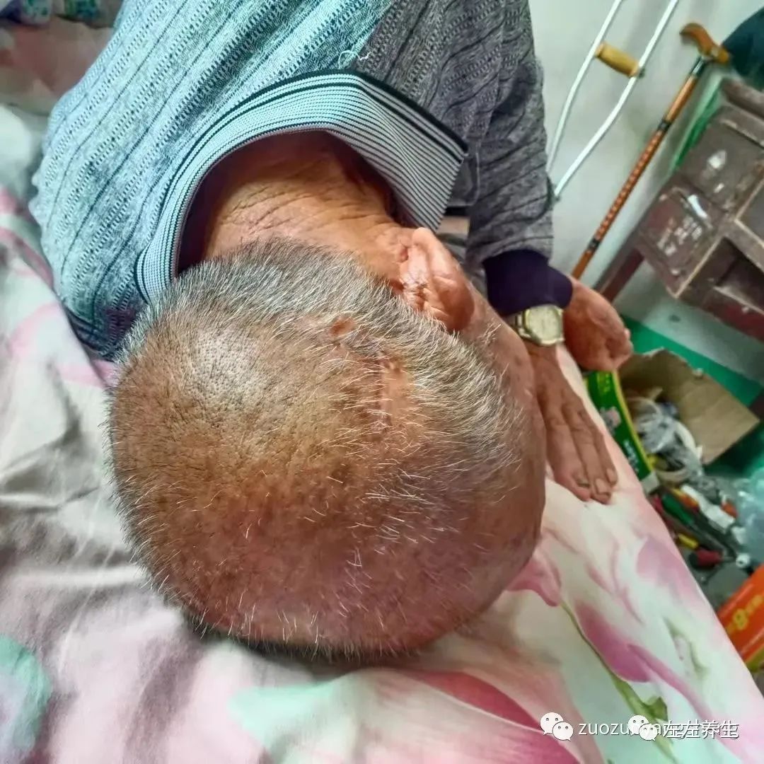 案例分享：85岁老人腿痛、无力，“种”发的案例