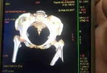 案例分享:又一奇迹:83岁婆婆骨折错位没开刀没手术6周康复-七不姜 生姜养生网-明德CSA生态姜园&明安农业