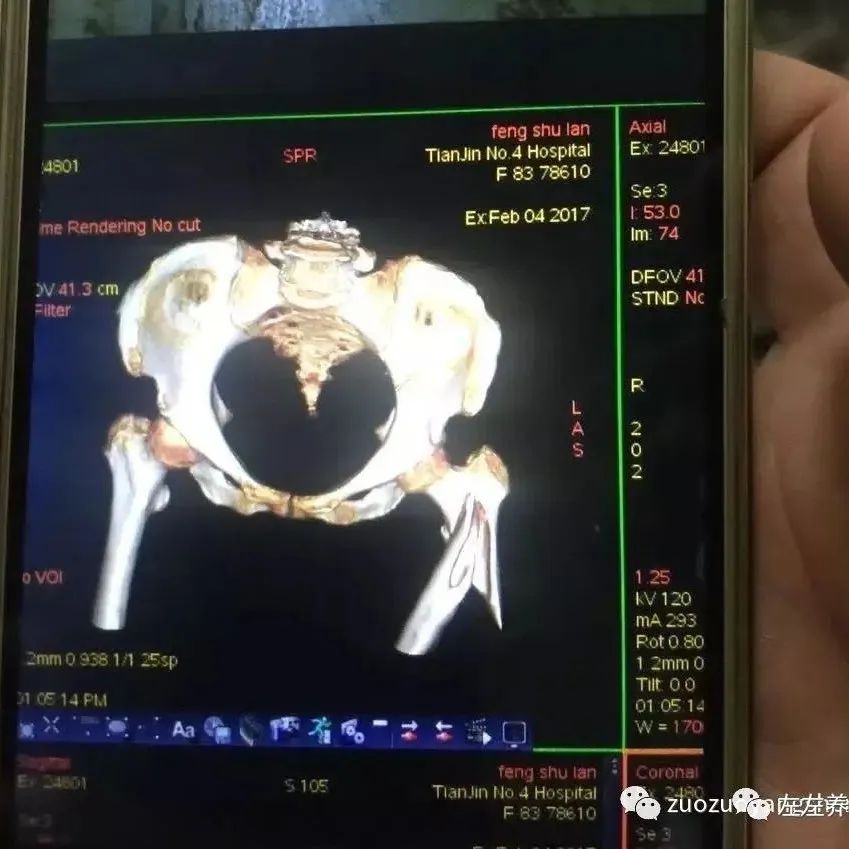 案例分享：又一奇迹：83岁婆婆骨折错位没开刀没手术6周康复-七不姜 生姜养生网-明德CSA生态姜园&明安农业