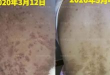 案例分享:产后高血压、全身奇痒无比调理案例-七不姜 生姜养生网-明德CSA生态姜园&明安农业