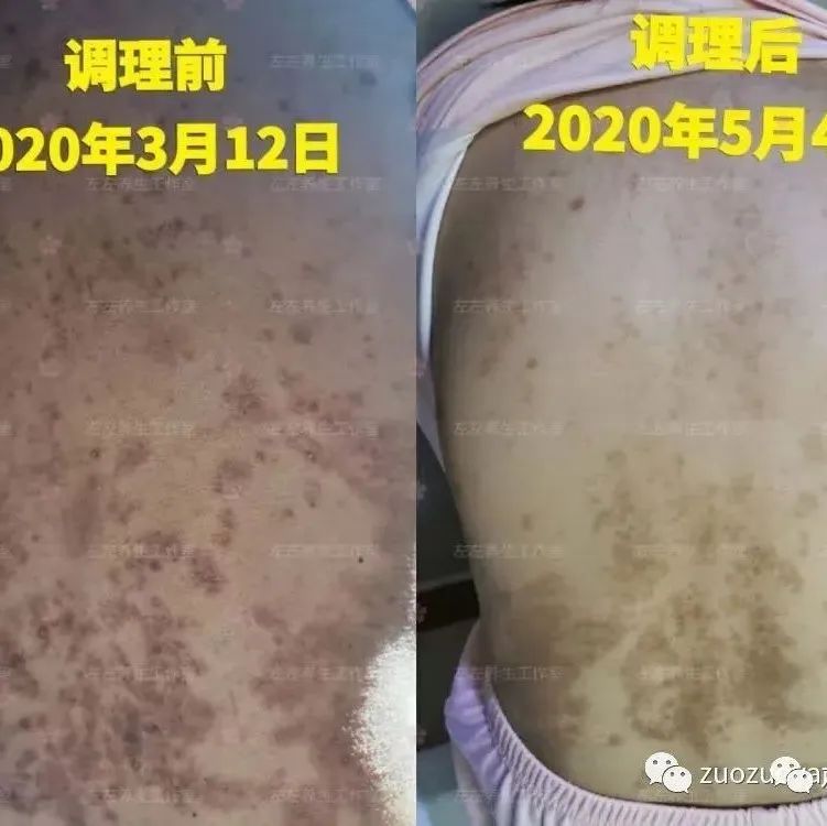 案例分享：产后高血压、全身奇痒无比调理案例-七不姜 生姜养生网-明德CSA生态姜园&明安农业