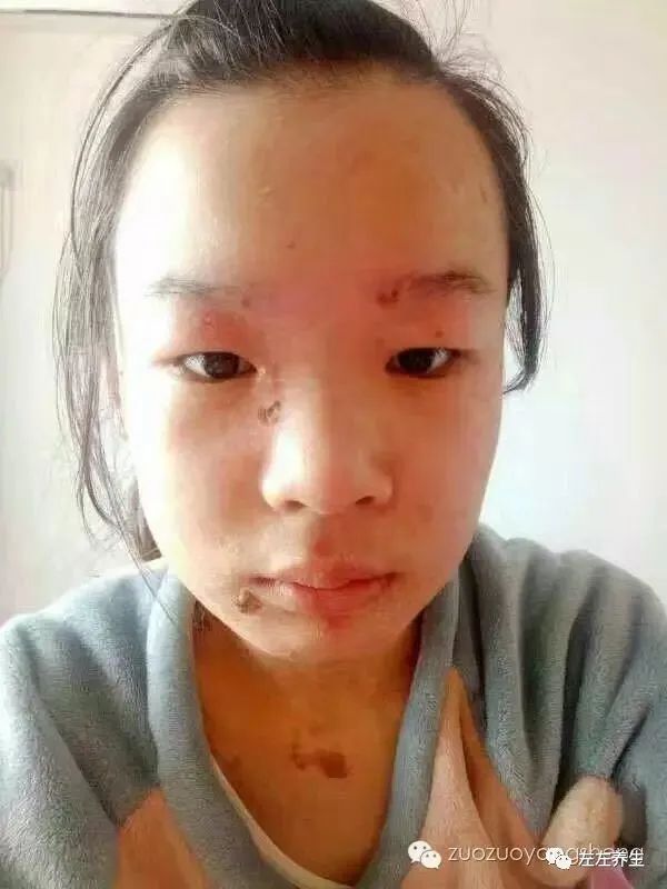 案例分享:花季少女面部烫伤不留疤的调理案例 案例分享:花季少女面部烫伤不留疤的调理案例