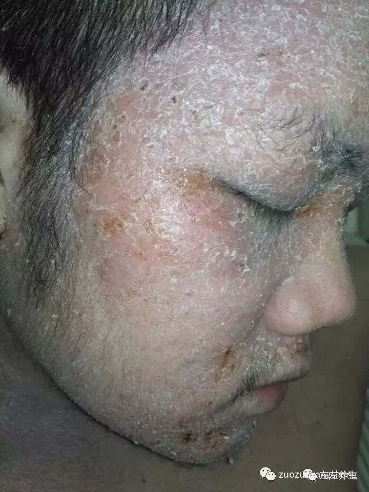 案例分享：马来西亚男孩严重湿疹、十天后大变样