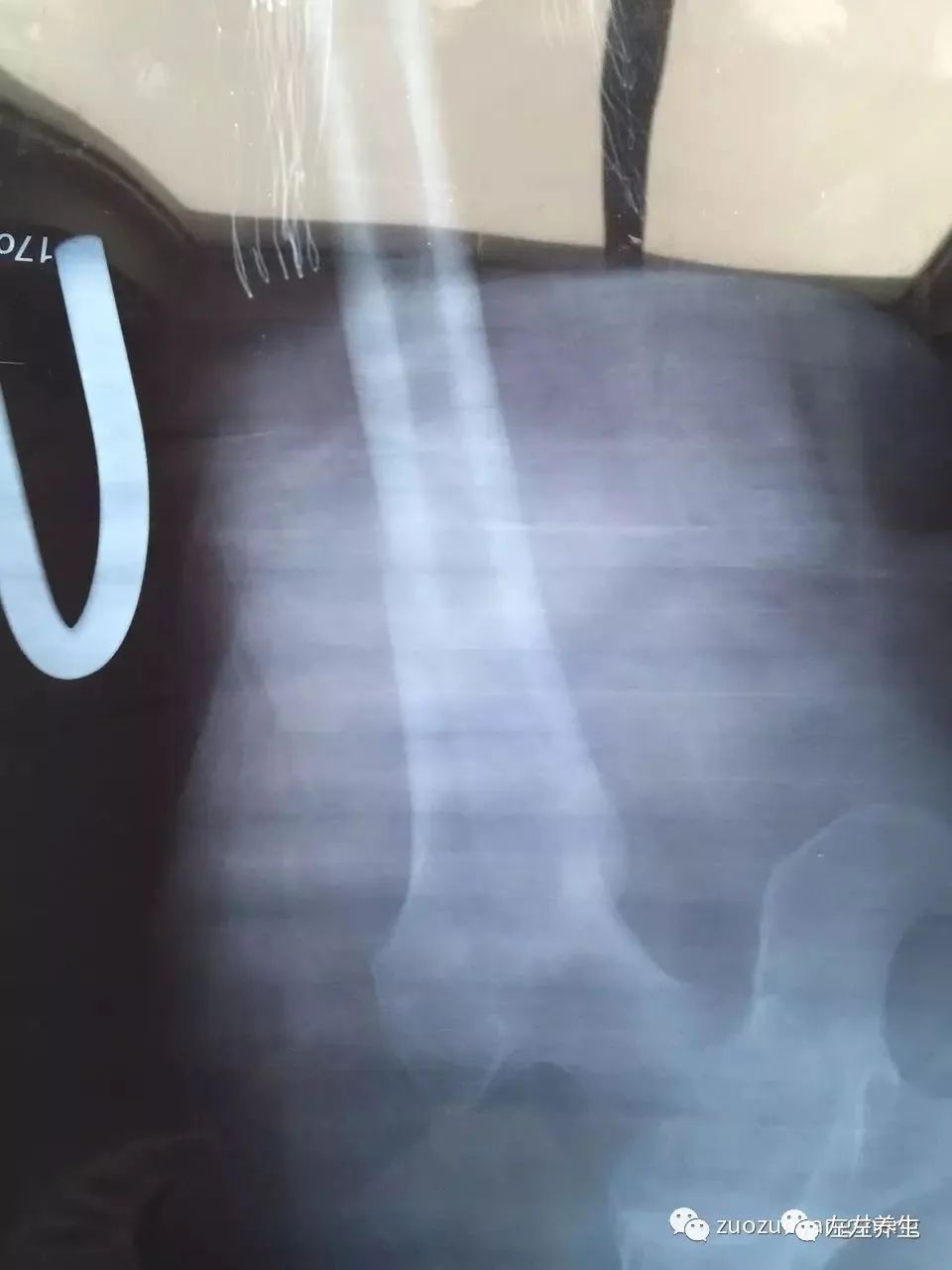 案例分享：又一奇迹：83岁婆婆骨折错位没开刀没手术6周康复