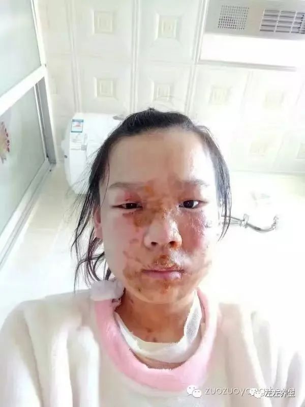 案例分享:花季少女面部烫伤不留疤的调理案例 案例分享:花季少女面部烫伤不留疤的调理案例