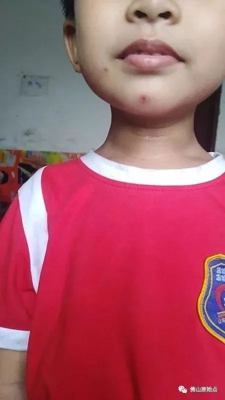 佛山原始点中心学员花开深圳:妈妈用原始点为七岁儿调理水痘9天康复案例 佛山原始点中心学员花开深圳:妈妈用原始点为七岁儿调理水痘9天康复案例