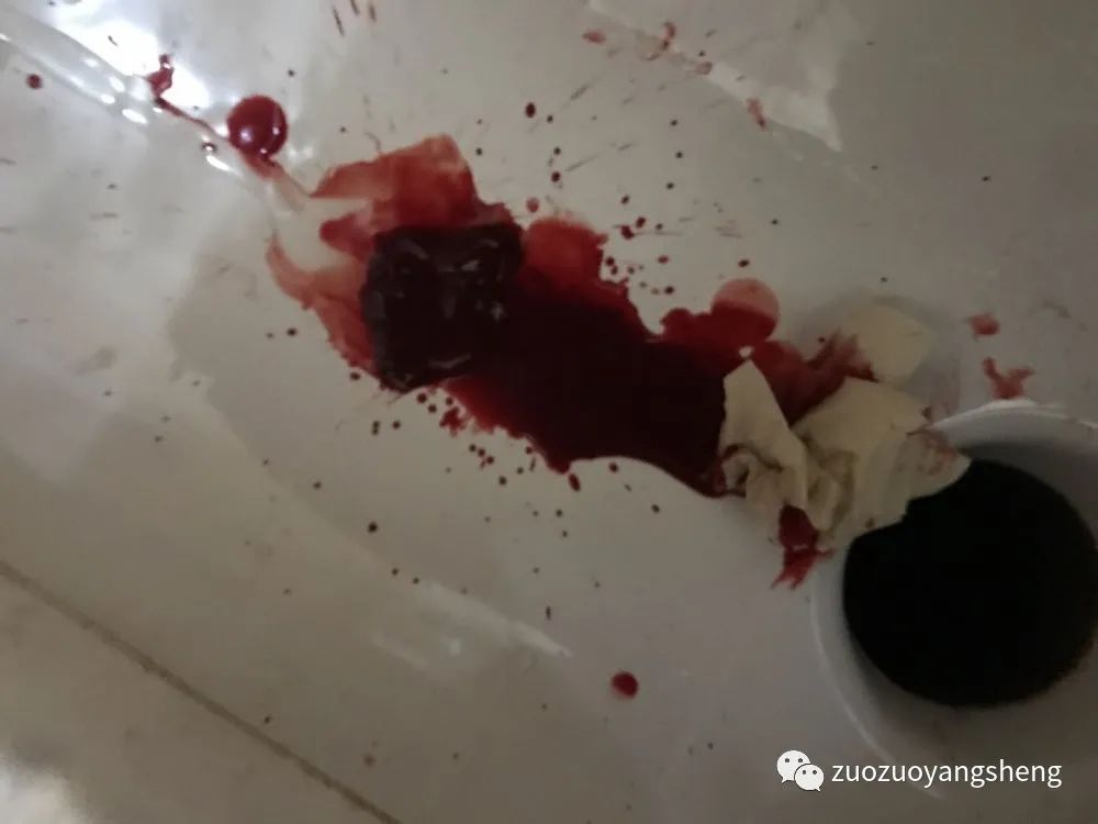 案例分享:原始点调理子宫大出血的案例 案例分享:原始点调理子宫大出血的案例