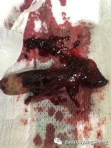 案例分享:原始点调理5天后排出胎死腹中案例 案例分享:原始点调理5天后排出胎死腹中案例