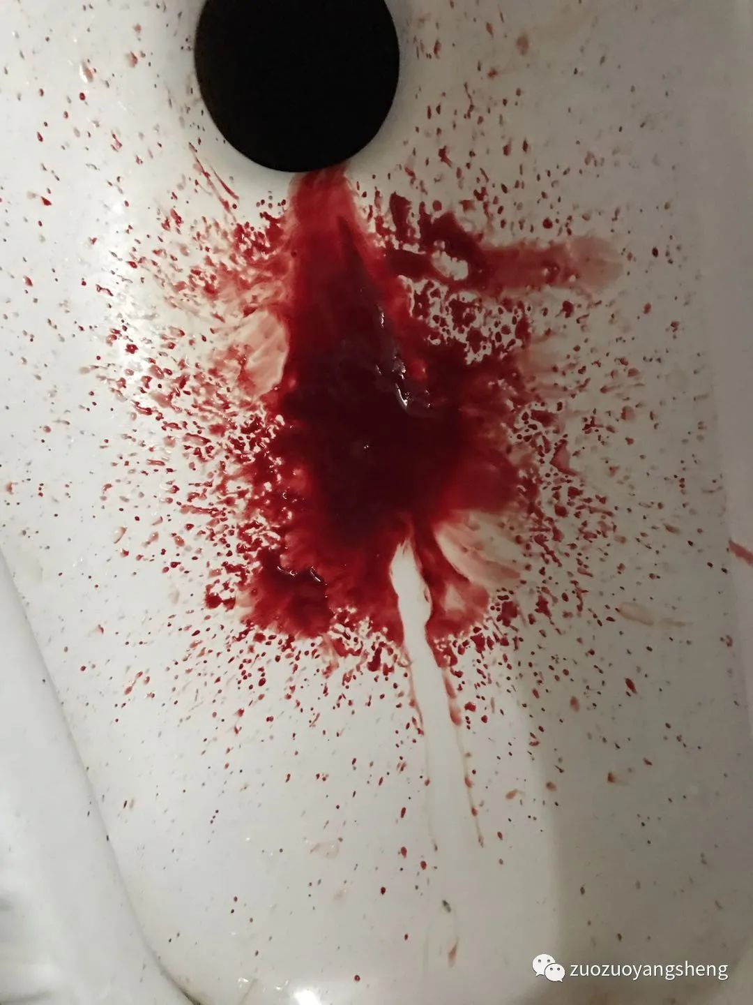 案例分享:原始点调理子宫大出血的案例 案例分享:原始点调理子宫大出血的案例