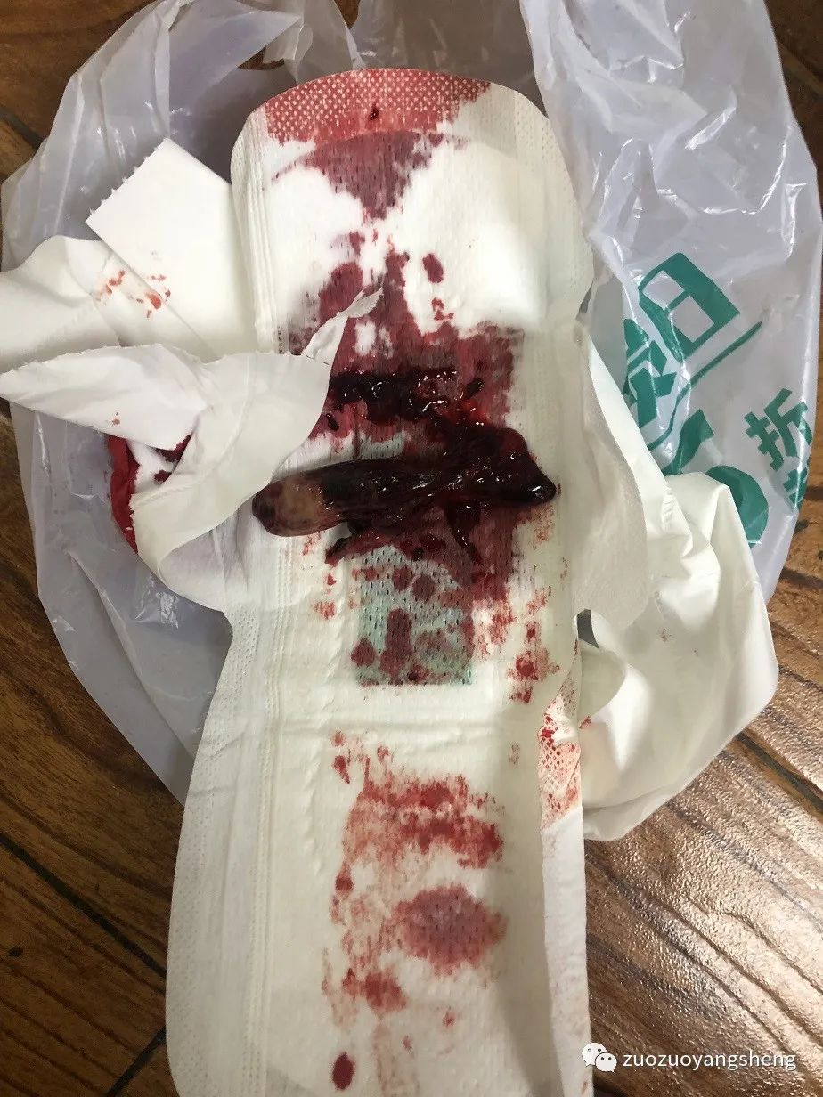 案例分享:原始点调理5天后排出胎死腹中案例 案例分享:原始点调理5天后排出胎死腹中案例